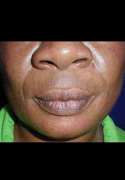 Radiesse Before & After