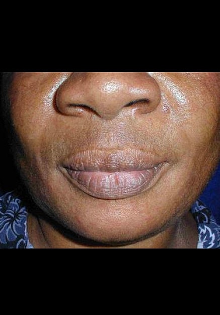 Radiesse Before & After