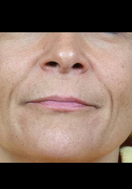 Radiesse Before & After