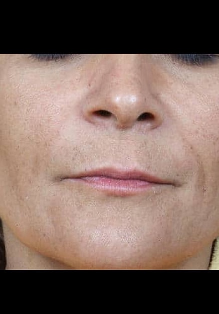 Radiesse Before & After