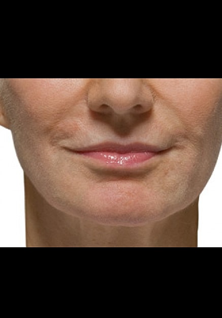 Radiesse Before & After