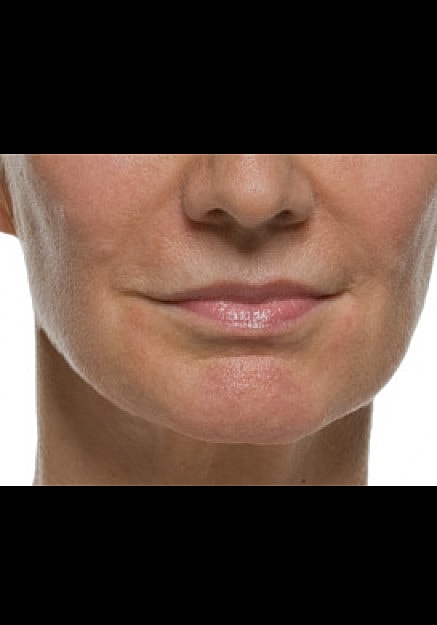Radiesse Before & After