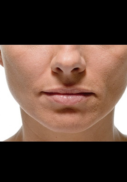 Radiesse Before & After