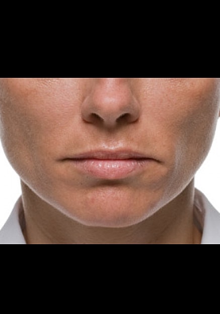 Radiesse Before & After