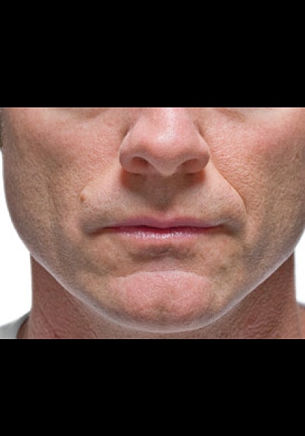 Radiesse Before & After