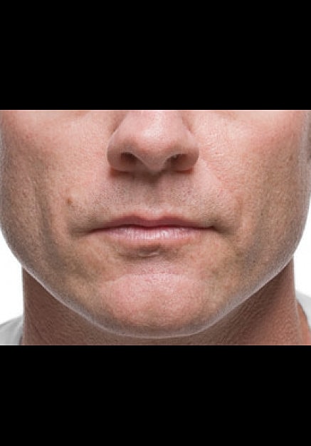 Radiesse Before & After