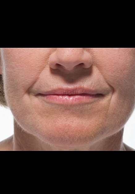 Radiesse Before & After