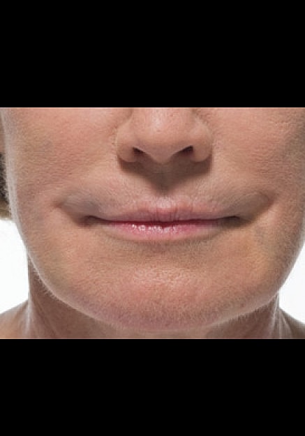 Radiesse Before & After