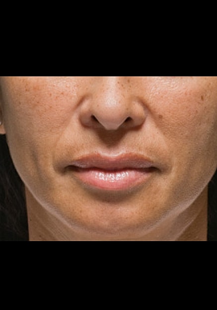 Radiesse Before & After
