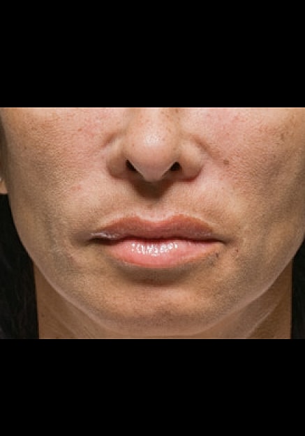 Radiesse Before & After