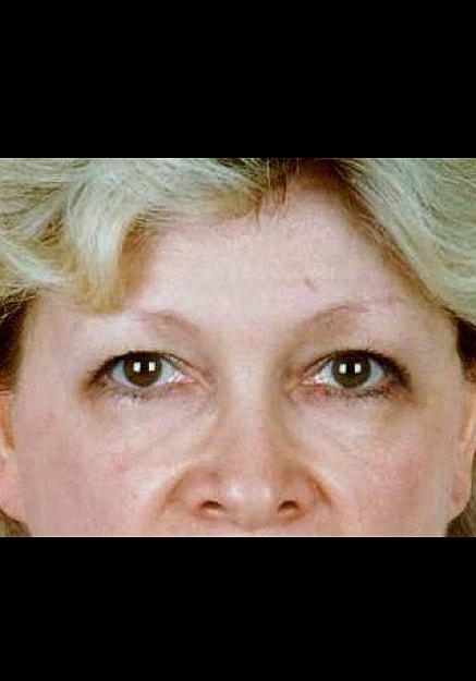 Eyelid Surgery Before & After