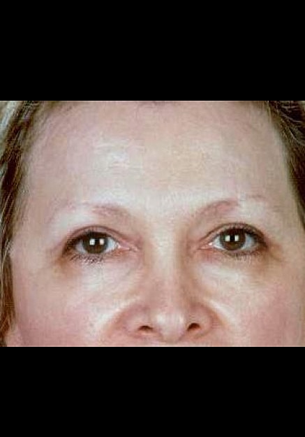 Eyelid Surgery Before & After