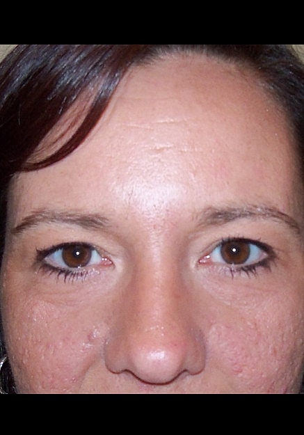 Eyelid Surgery Before & After