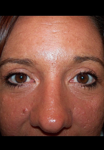 Eyelid Surgery Before & After