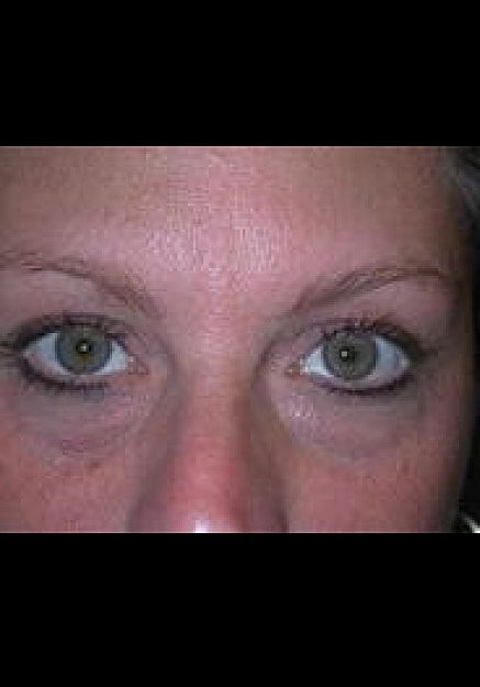 Eyelid Surgery Before & After