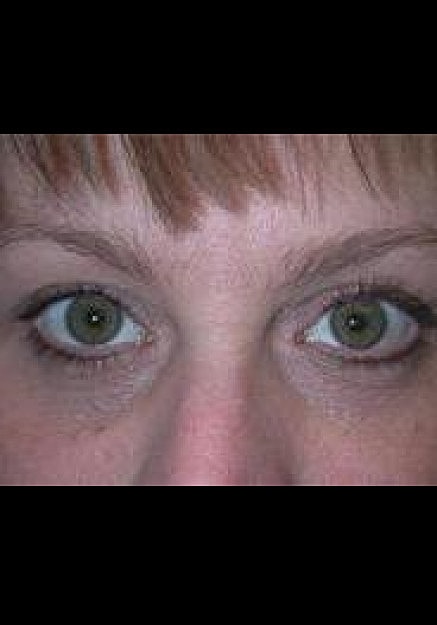 Eyelid Surgery Before & After