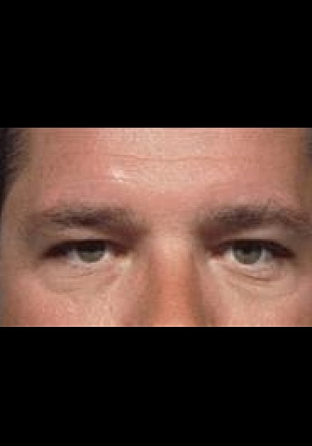 Eyelid Surgery Before & After
