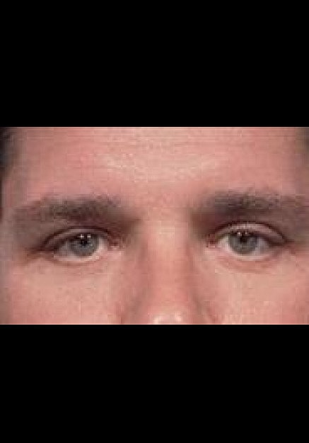 Eyelid Surgery Before & After