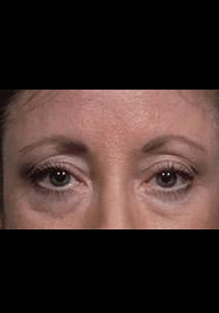 Eyelid Surgery Before & After