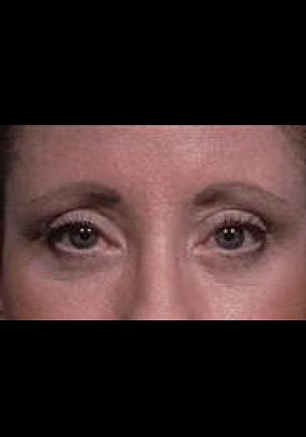 Eyelid Surgery Before & After