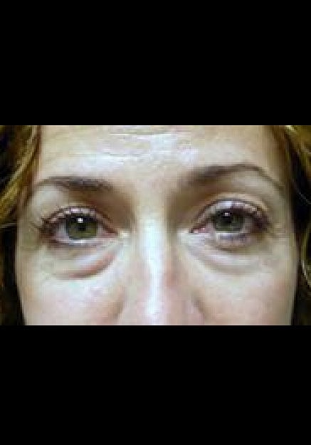 Eyelid Surgery Before & After