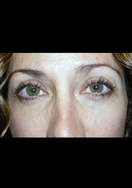 Eyelid Surgery Before & After