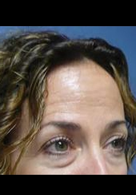Eyelid Surgery Before & After