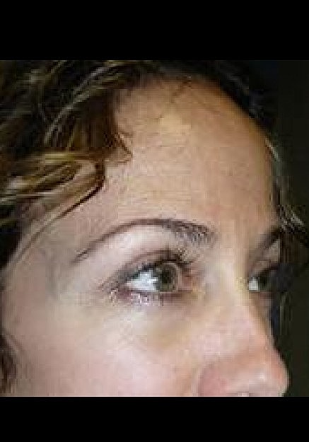 Eyelid Surgery Before & After