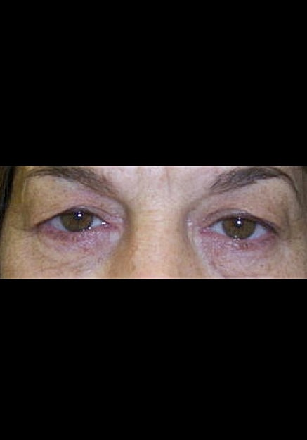 Eyelid Surgery Before & After