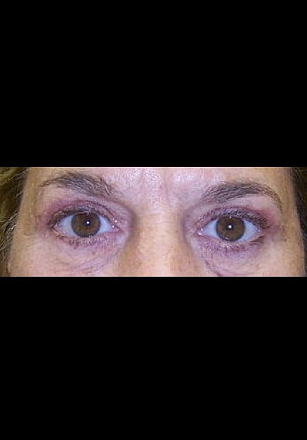 Eyelid Surgery Before & After