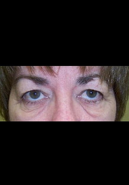 Eyelid Surgery Before & After