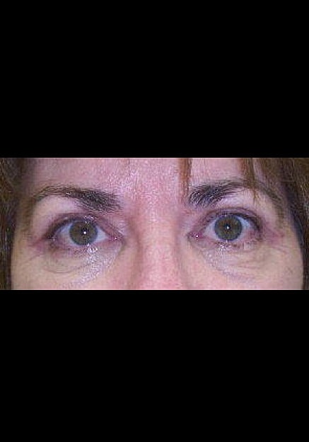 Eyelid Surgery Before & After