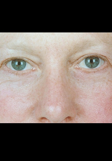 Eyelid Surgery Before & After