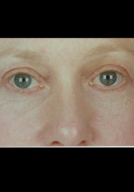 Eyelid Surgery Before & After