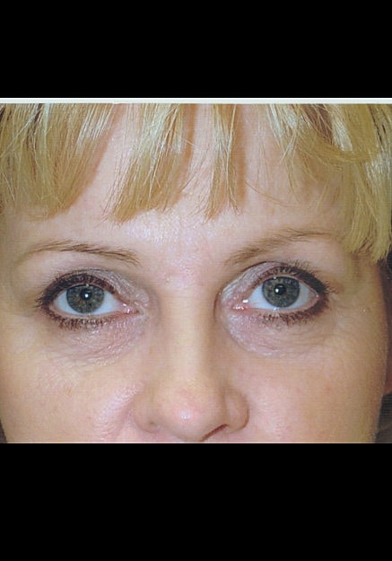 Eyelid Surgery Before & After