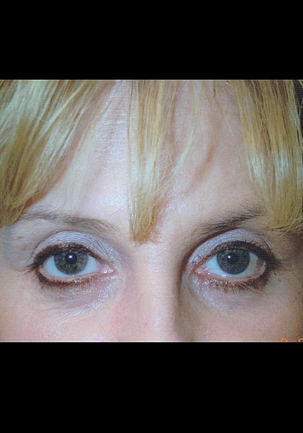 Eyelid Surgery Before & After