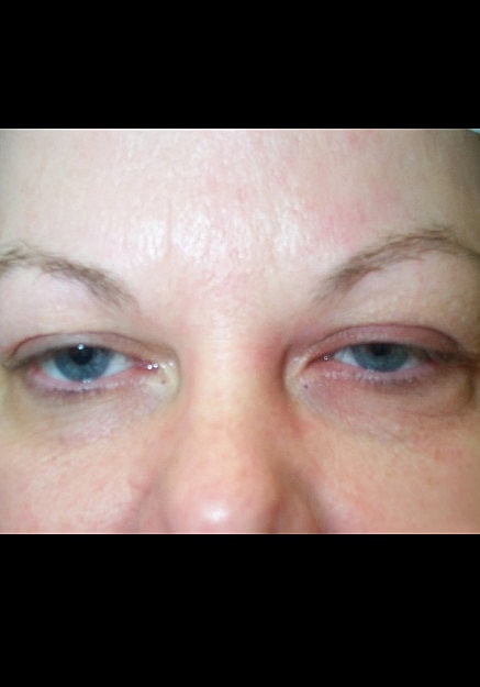 Eyelid Surgery Before & After
