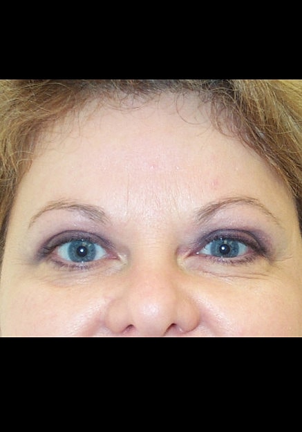 Eyelid Surgery Before & After