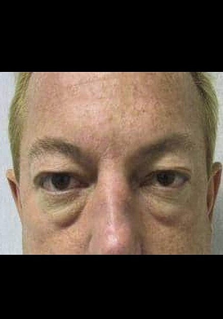 Eyelid Surgery Before & After