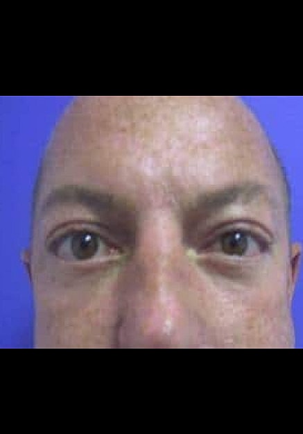 Eyelid Surgery Before & After