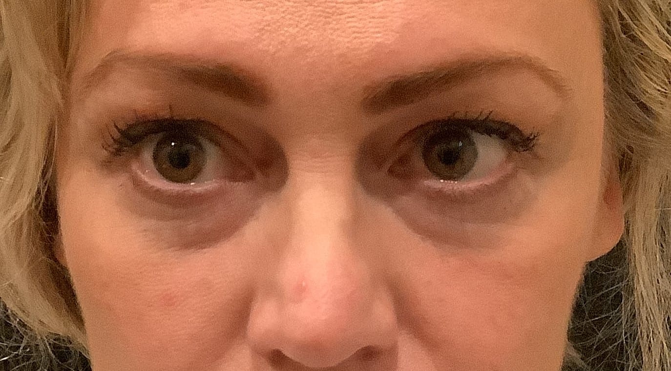 Eyelid Surgery Before & After