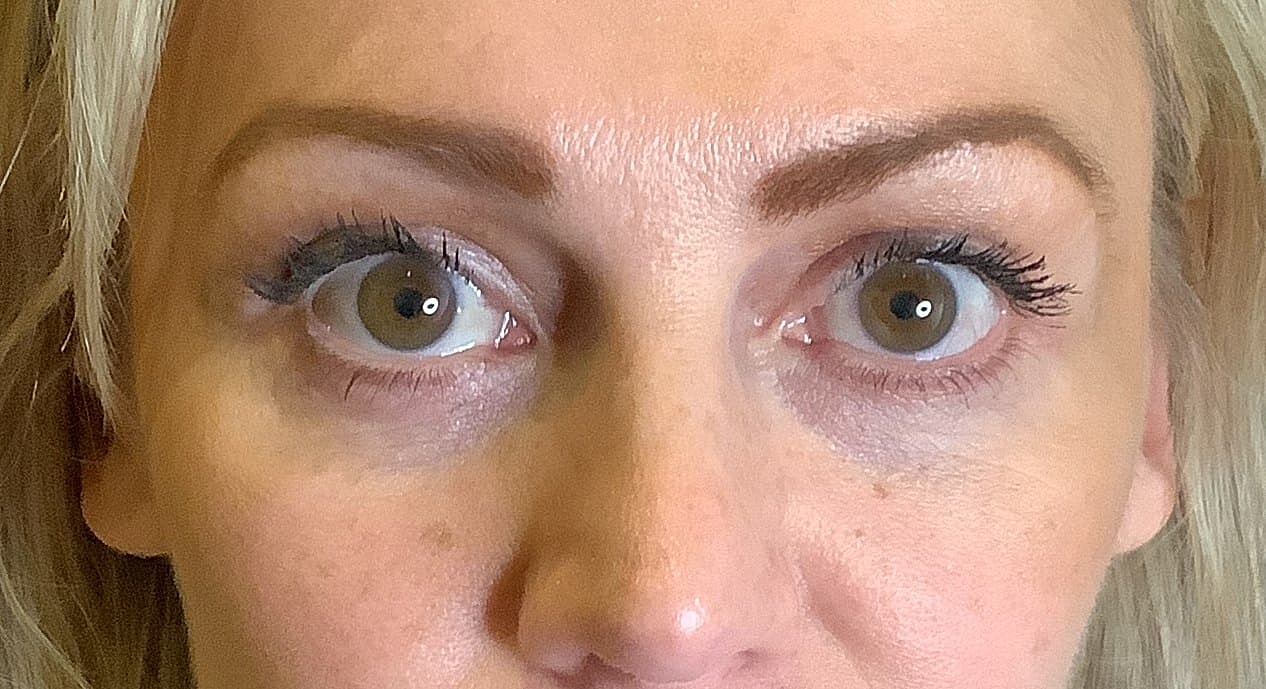 Eyelid Surgery Before & After