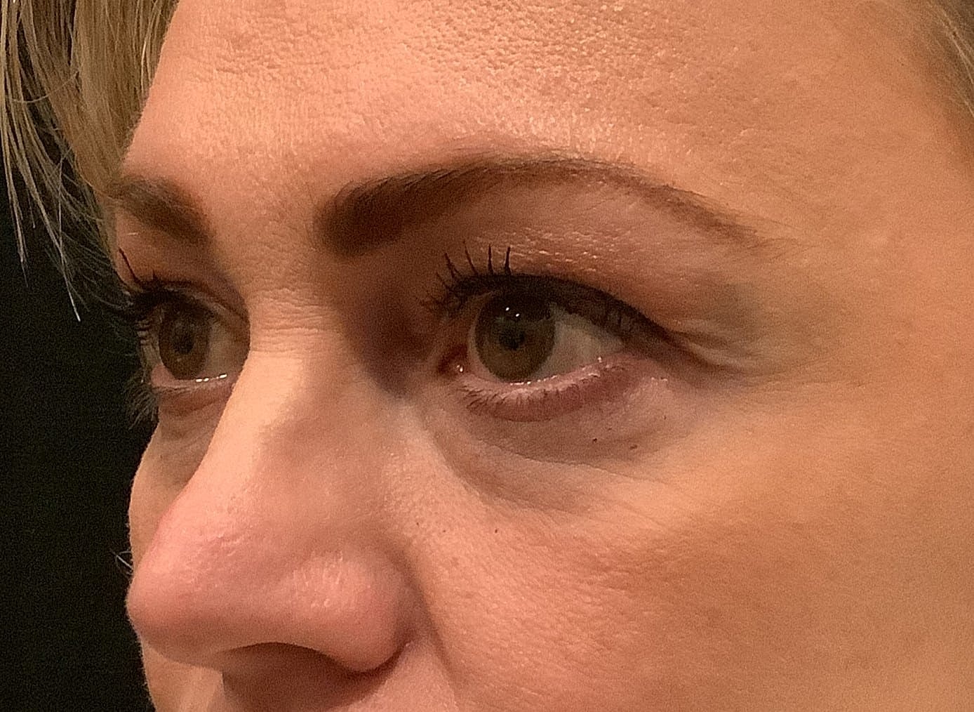 Eyelid Surgery Before & After