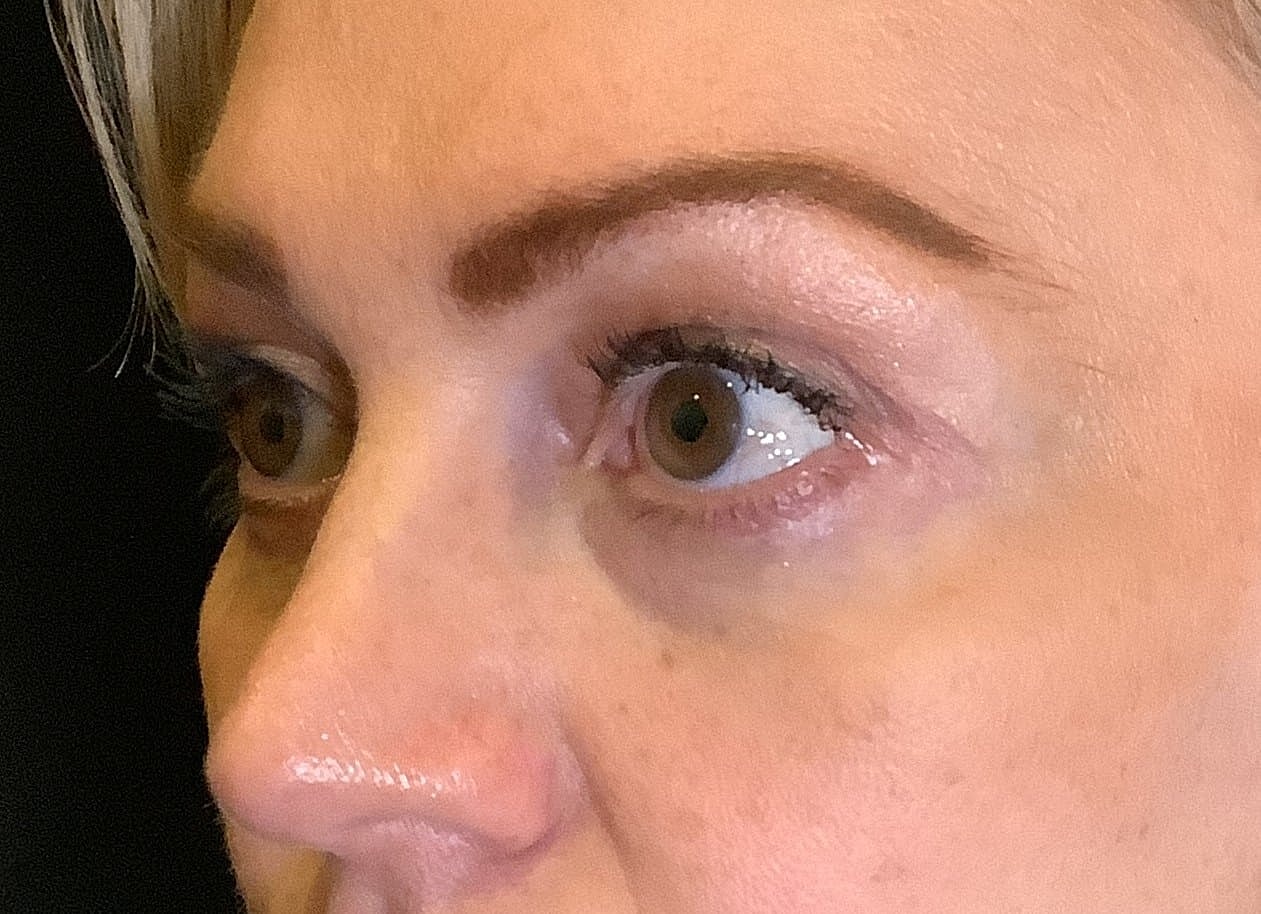 Eyelid Surgery Before & After