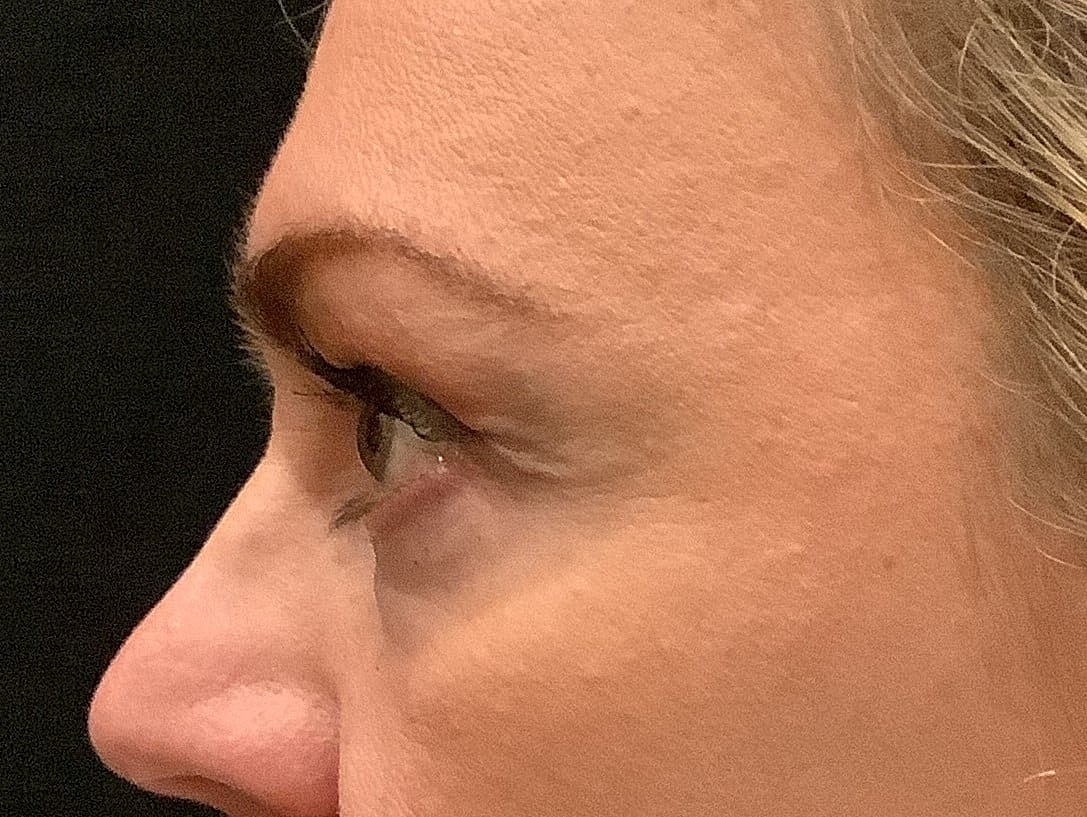 Eyelid Surgery Before & After