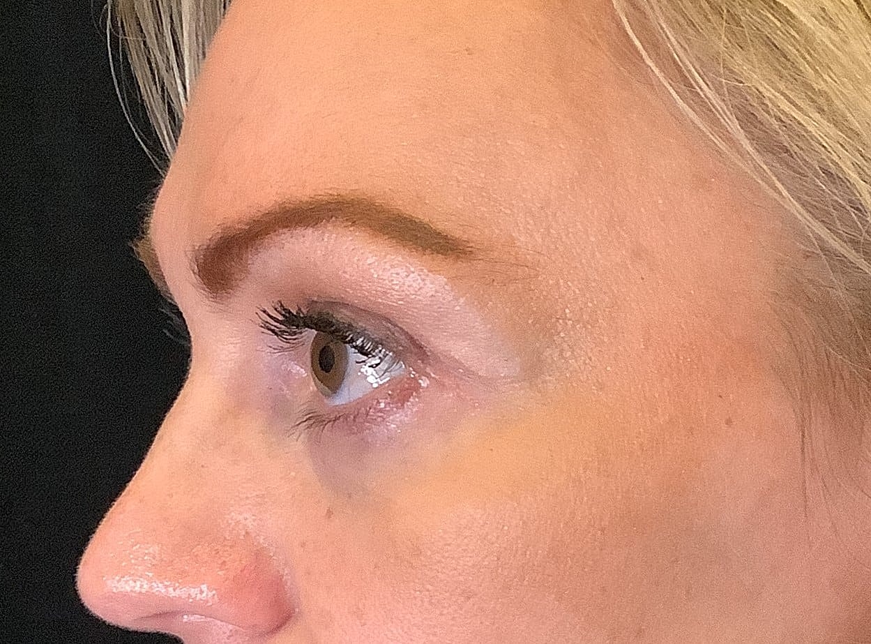 Eyelid Surgery Before & After