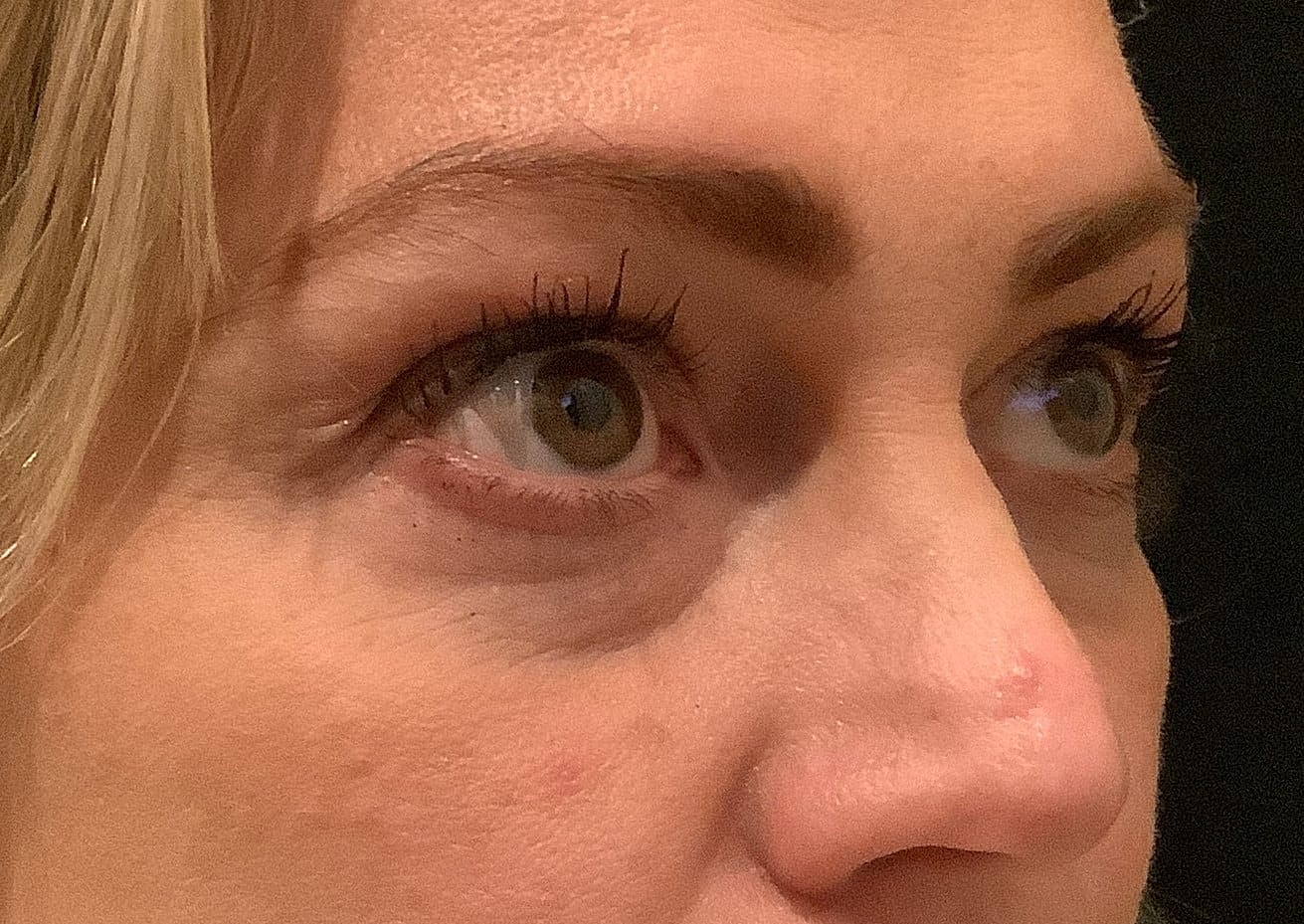 Eyelid Surgery Before & After