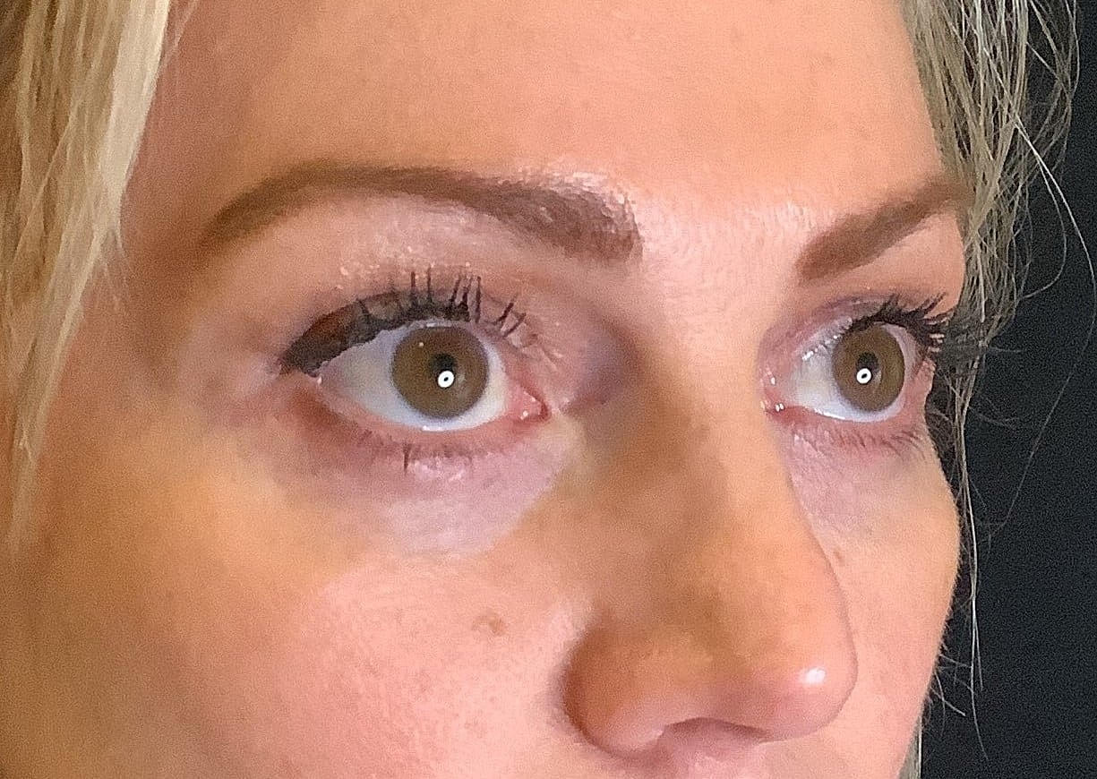 Eyelid Surgery Before & After