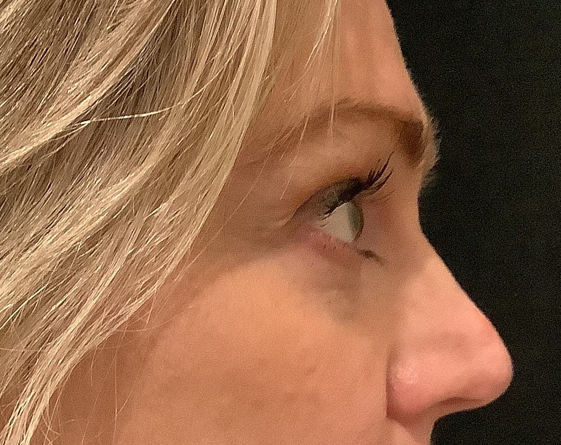 Eyelid Surgery Before & After