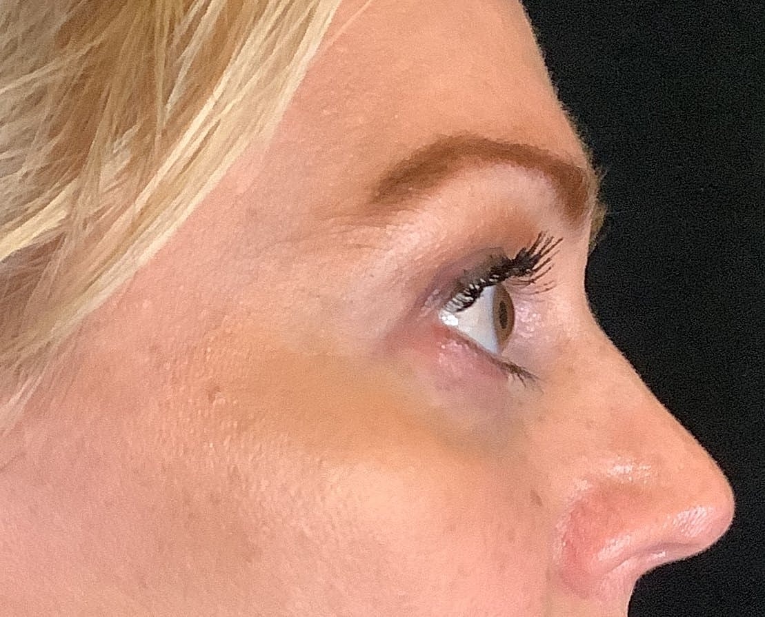 Eyelid Surgery Before & After